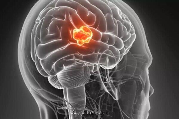 تست جدید نوع تومور مغزی را دو ساعته تشخیص می دهد
